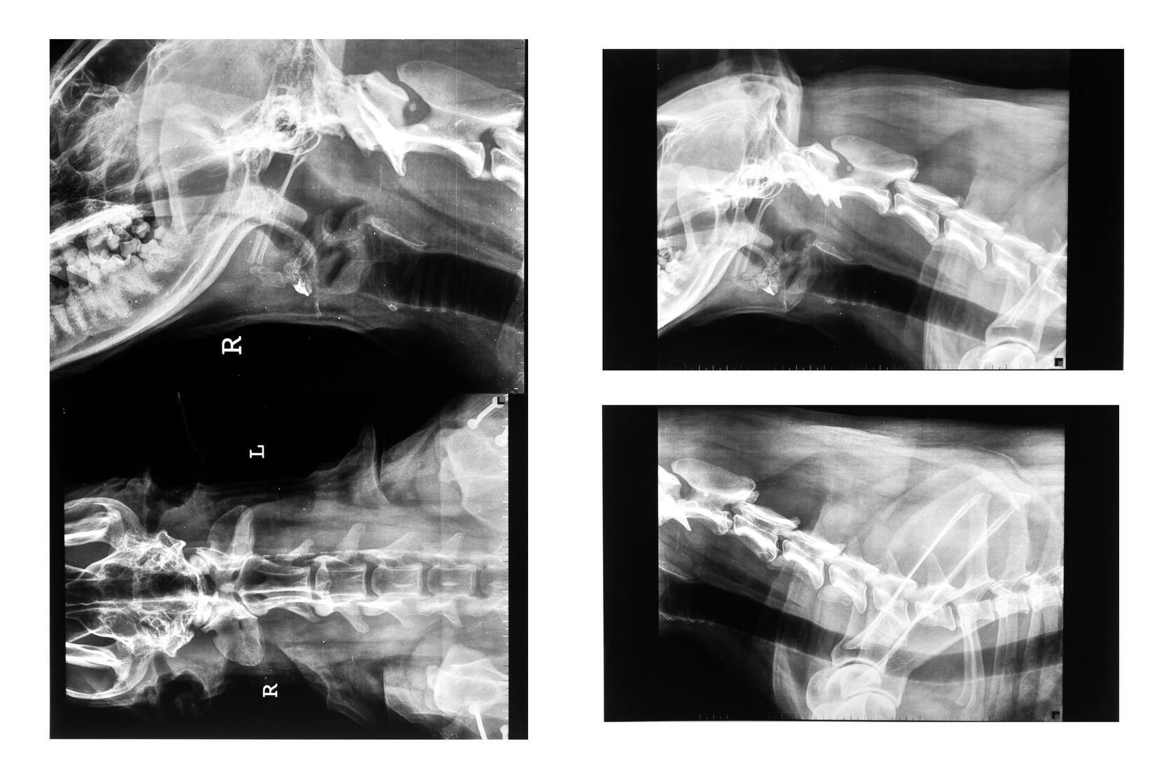 Neck Injuries